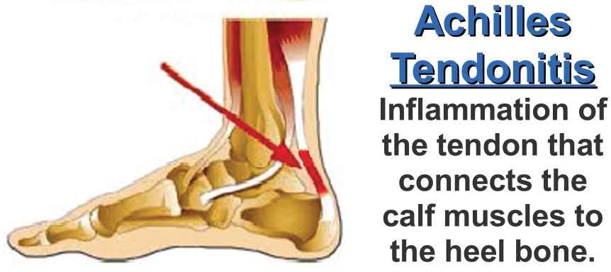 plantar fasciitis