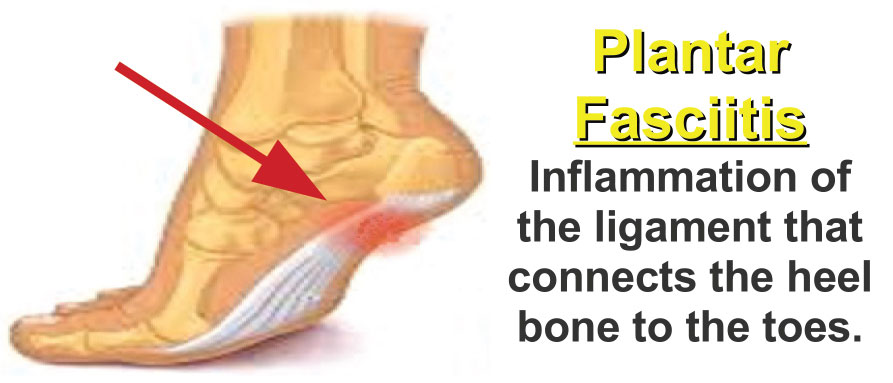plantar fasciitis