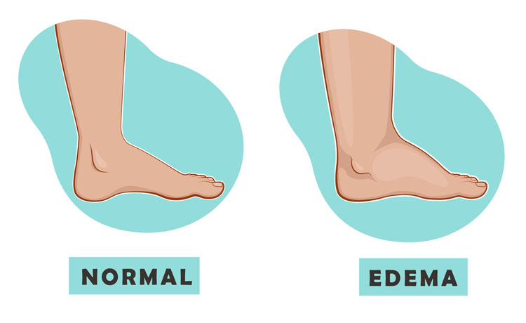 foot swelling causes solutions