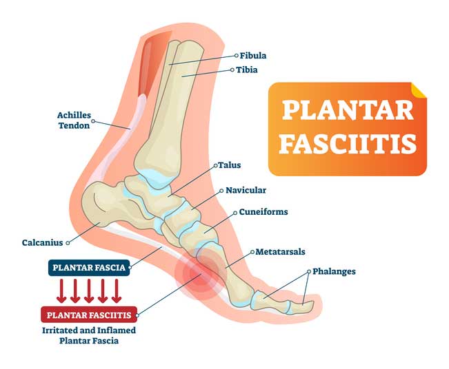 plantar-fasciitis-diagram plantar-fasciitis-diagram